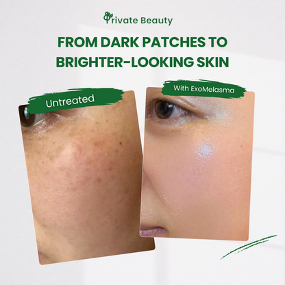 Private Beauty Exo Melasma Care