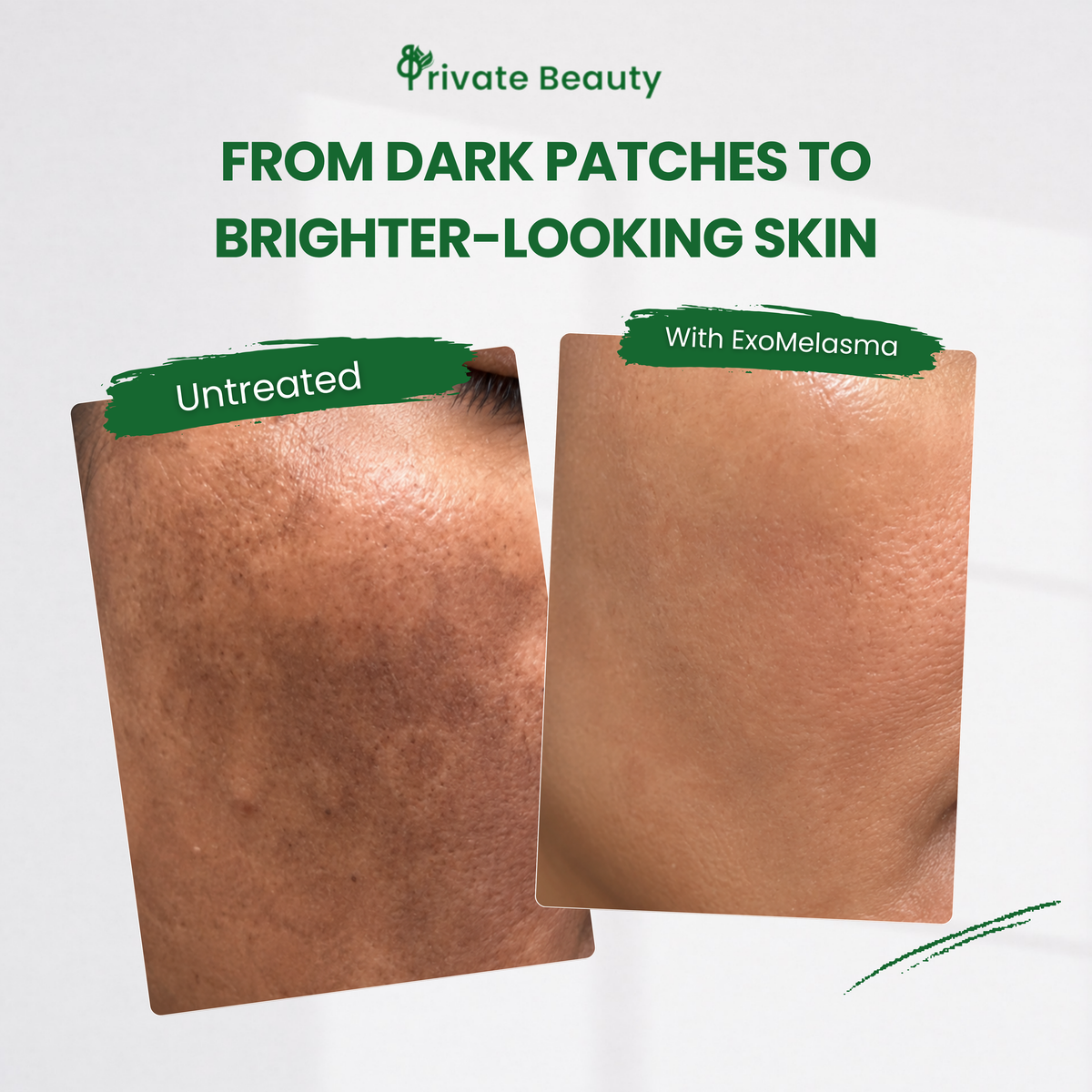 Private Beauty Exo Melasma Care